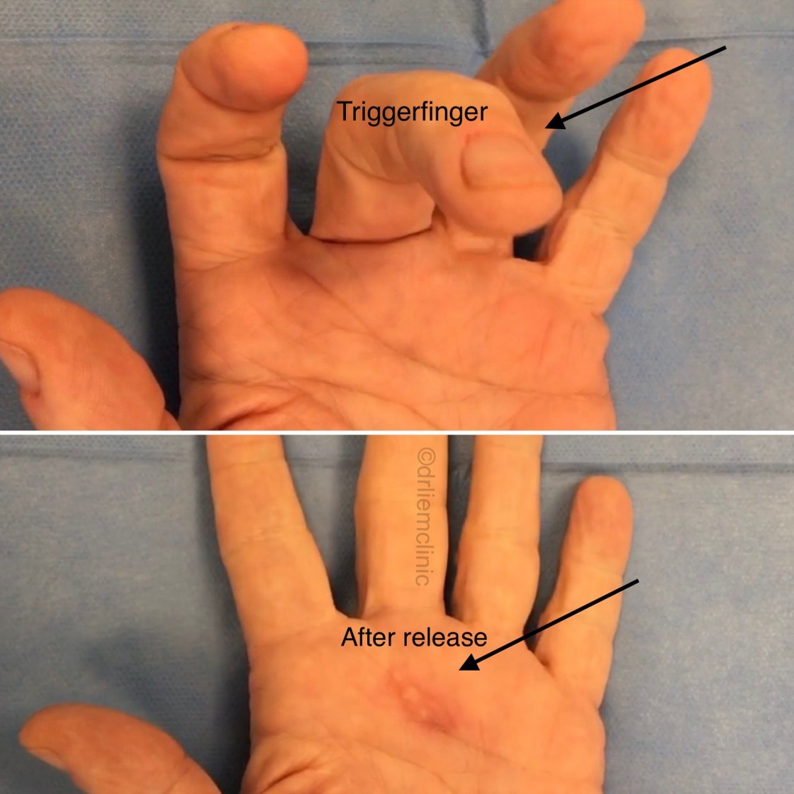 Grillig Gorgelen Toestemming Handen Correctie - Dr. Liem Clinic