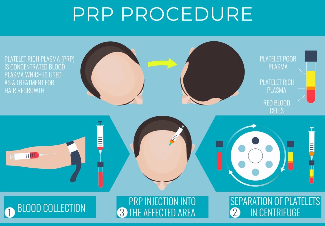 Dr. Liem Clinic - Prp Behandeling